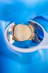 Tooth kept in a small container to stay moist until the dentist visit