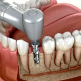 Dental Implants in Scarborough