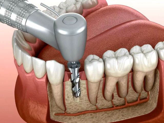 Looking for Dental Implants in Scarborough? Why AF Dental is the Top Choice